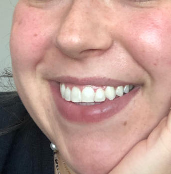 Blanqueador Dental VogaCol