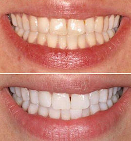 Blanqueador Dental VogaCol