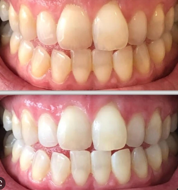 Blanqueador Dental VogaCol